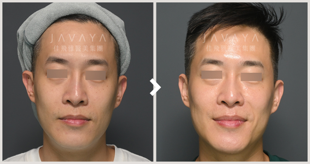 肉毒注射咀嚼肌｜見證案例_09